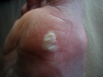 The Mighty Blister